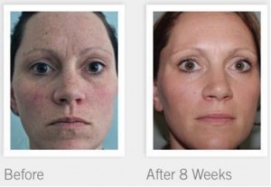 Rodan + Fields Before and After